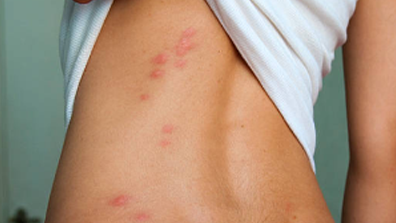 Rote, juckende Hautausschläge auf dem Rücken einer Person, verursacht durch Bettwanzenbisse